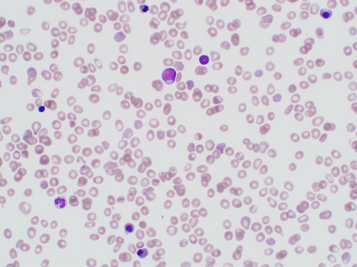 Peripheral blood smear showing circulating blasts, polychromasia and NRBCs.